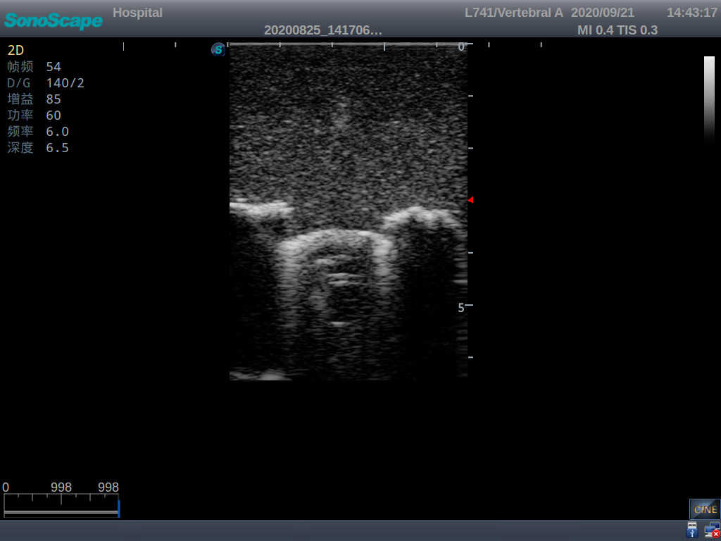 Pediatric Lumbar Puncture Ultrasound Training Model